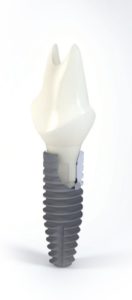 dental implants waterford ct