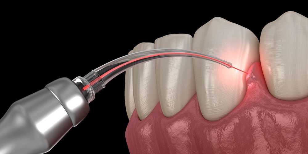lanap treatment