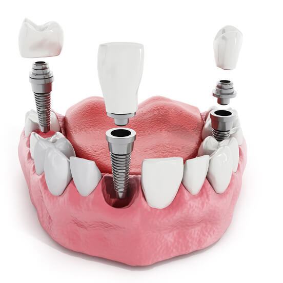 Traditional Implants Model
