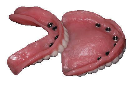 Snap In Smile Implant Supported Dentures